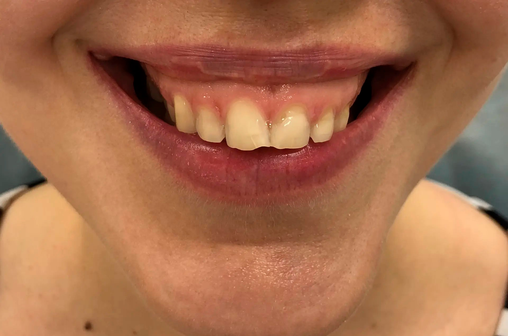 До процедуры коррекции десневой улыбки — gummy smile